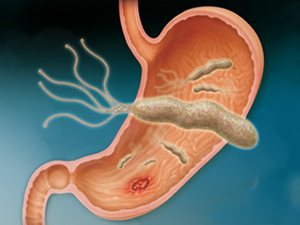 Helicobacter Pylori